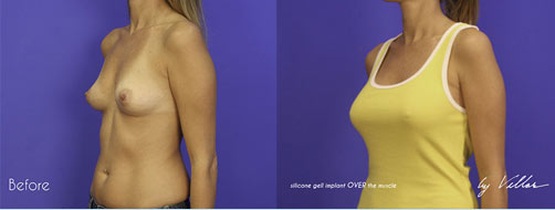 Breast Augmentation - Before and After Dr Villar 4