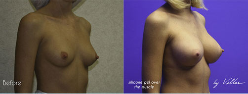Breast Augmentation - Before and After Dr Villar 8