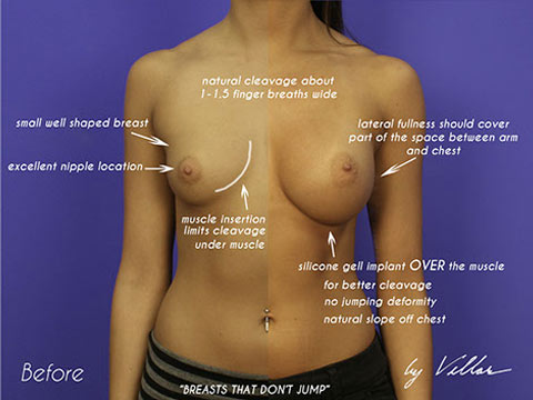 Breast Augmentation - Before and After Dr Villar 1
