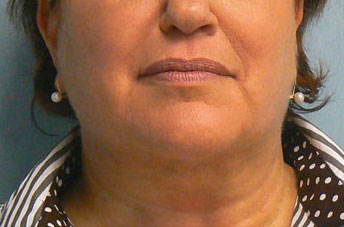 After Face Neck SmartLipo