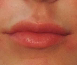 After Lip Enhancement