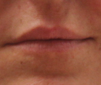 Before Lip Enhancement