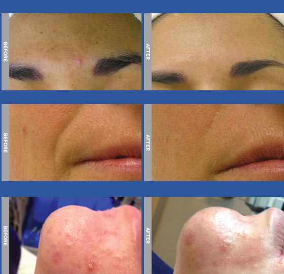 Before and after photos - Before_After_Hydrafacial MD in Ft Lauderdale