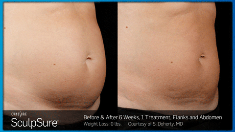 Before and After Photos of SculpSure Patients - Body Care Ft Lauderdale 33301