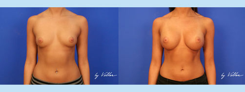 Breast Augmentation - Before and After Dr Villar 1