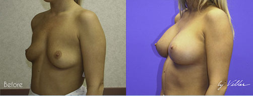 Breast Augmentation - Before and After Dr Villar 10