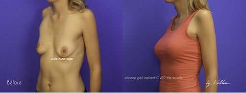 Breast Augmentation - Before and After Dr Villar 2