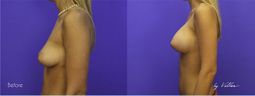 Breast Augmentation - Before and After Dr Villar 3