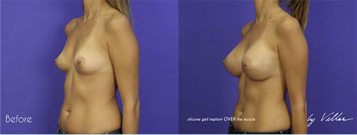 Breast Augmentation - Before and After Dr Villar 4