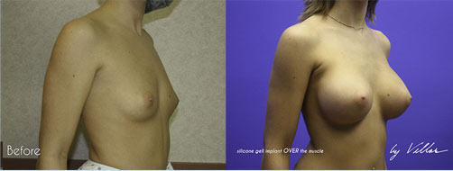 Breast Augmentation - Before and After Dr Villar 5