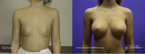 Breast Augmentation - Before and After Dr Villar 5