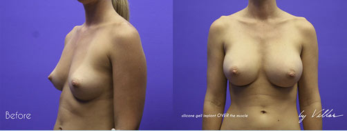 Breast Augmentation - Before and After Dr Villar 6