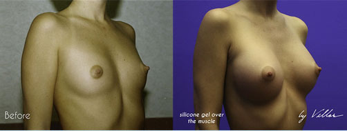 Breast Augmentation - Before and After Dr Villar 7