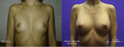 Breast Augmentation - Before and After Dr Villar 7