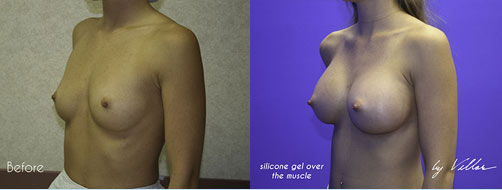 Breast Augmentation - Before and After Dr Villar 2