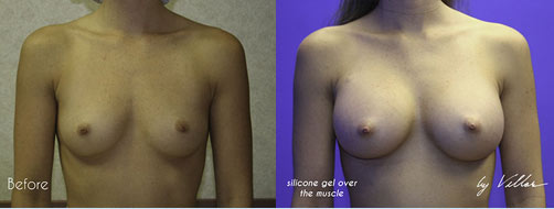 Breast Augmentation - Before and After Dr Villar 9