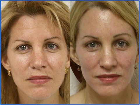 face plastic surgery