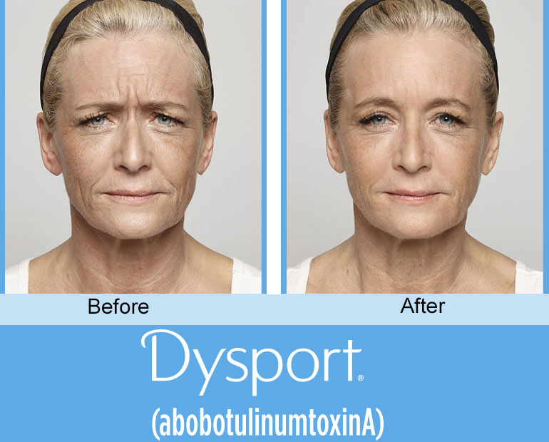 before and after dysport