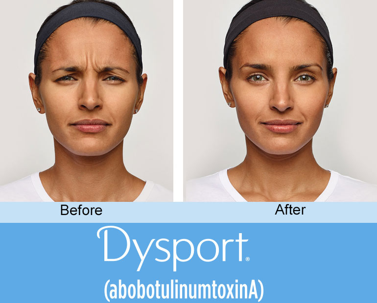 Dysport in Ft Lauderdale -- add volume to aging cheeks