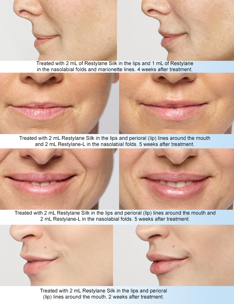 Juvéderm in Ft Lauderdale -- add volume to aging cheeks