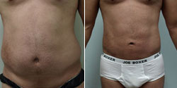SmartLipo Before and After