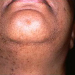 After Face Laser Hair Removal