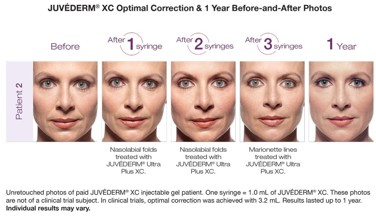 juvederm before and after photos in ft lauderdale