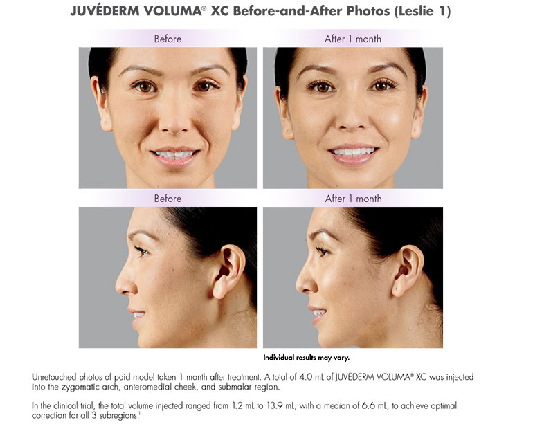 Juvéderm VOLUMA® XC in Ft Lauderdale. Unretouched photos of paid model taken 1 month after treatment. A total of 4.0 mL of JUVÉDERM VOLUMA® XC was injected
into the zygomatic arch, anteromedial cheek, and submalar region.
In the clinical trial, the total volume injected ranged from 1.2 mL to 13.9 mL, with a median of 6.6 mL, to achieve optimal
correction for all 3 subregions.