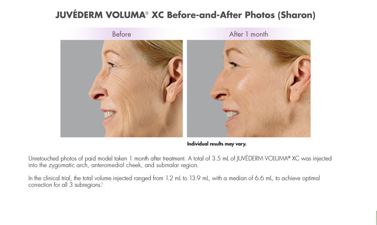 juvederm VOLUMA® XC Ft Lauderdale, Miami, Caribbean-- Unretouched photos of paid model taken 1 month after treatment. A total of 3.5 mL of JUVÉDERM VOLUMA® XC was injected
into the zygomatic arch, anteromedial cheek, and submalar region.
In the clinical trial, the total volume injected ranged from 1.2 mL to 13.9 mL, with a median of 6.6 mL, to achieve optimal
correction for all 3 subregions.1