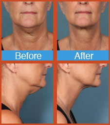 Kybella before and after ft lauderdale